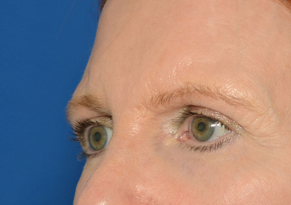 Brow Lift Before & After Photo #5