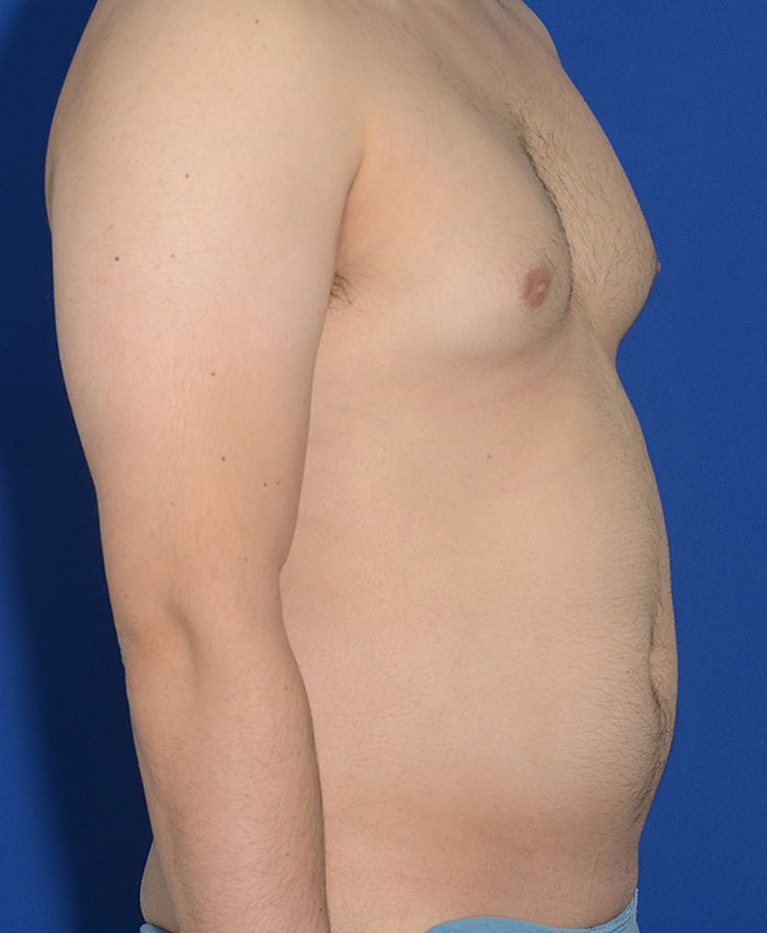 Liposuction Before & After Photo #9