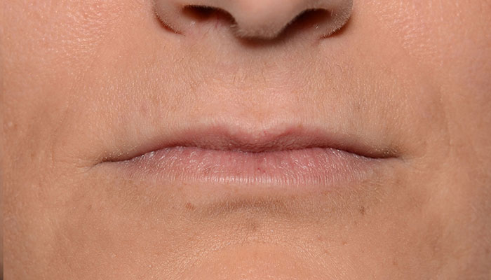 Lips Before & After Photo #1