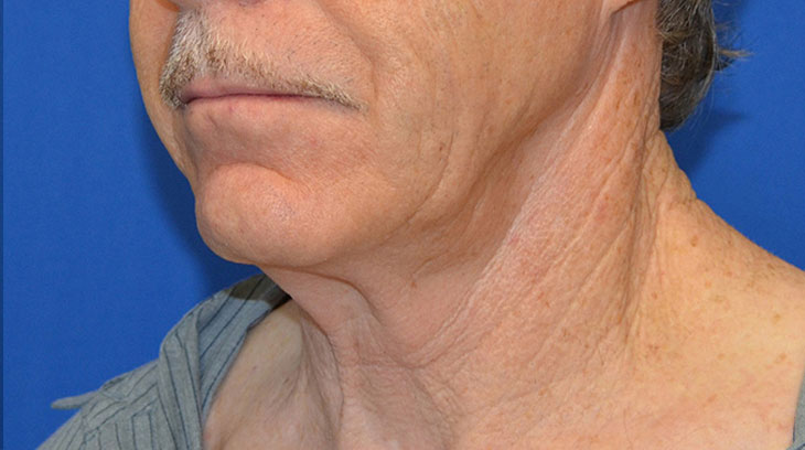 Neck Lift Before & After Photo #5