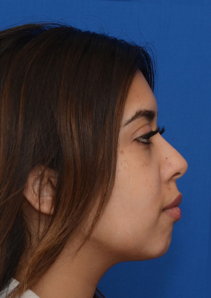 Non Surgical Chin Augmentation Before & After Photo #10