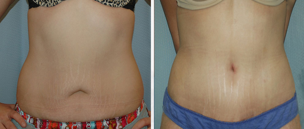 Tummy Tuck Surgery Results