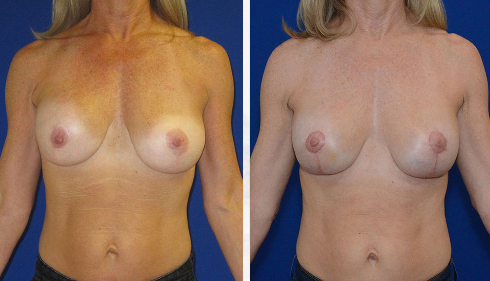 Northern Virginia Breast Lift Surgery Results