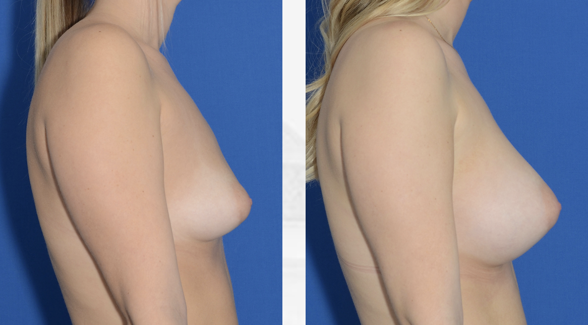 Breast Implants Northern Virginia