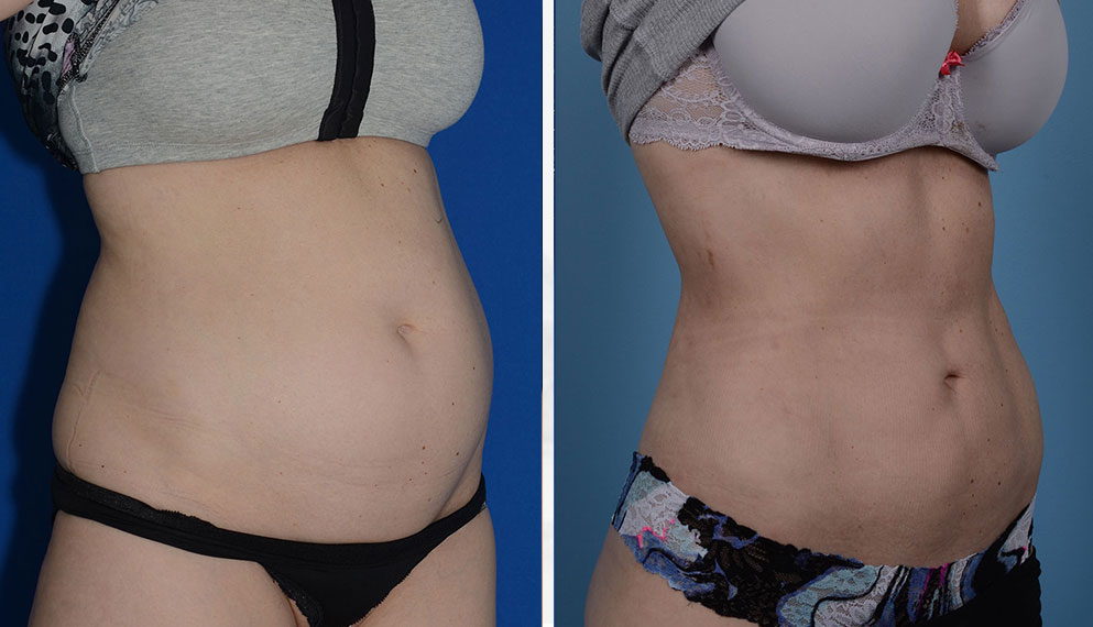 Liposuction Surgery Results