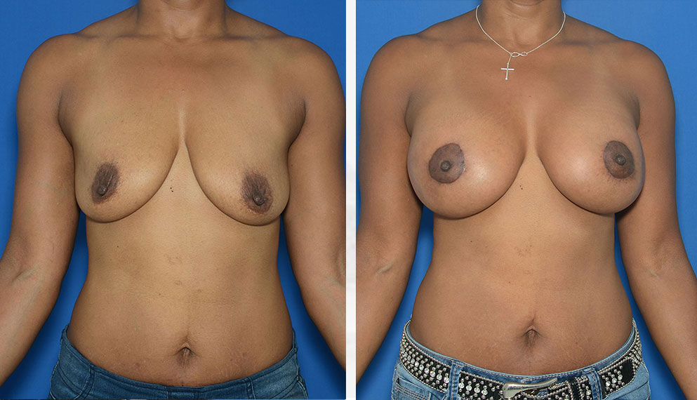 Washington DC Breast Lift Before & After