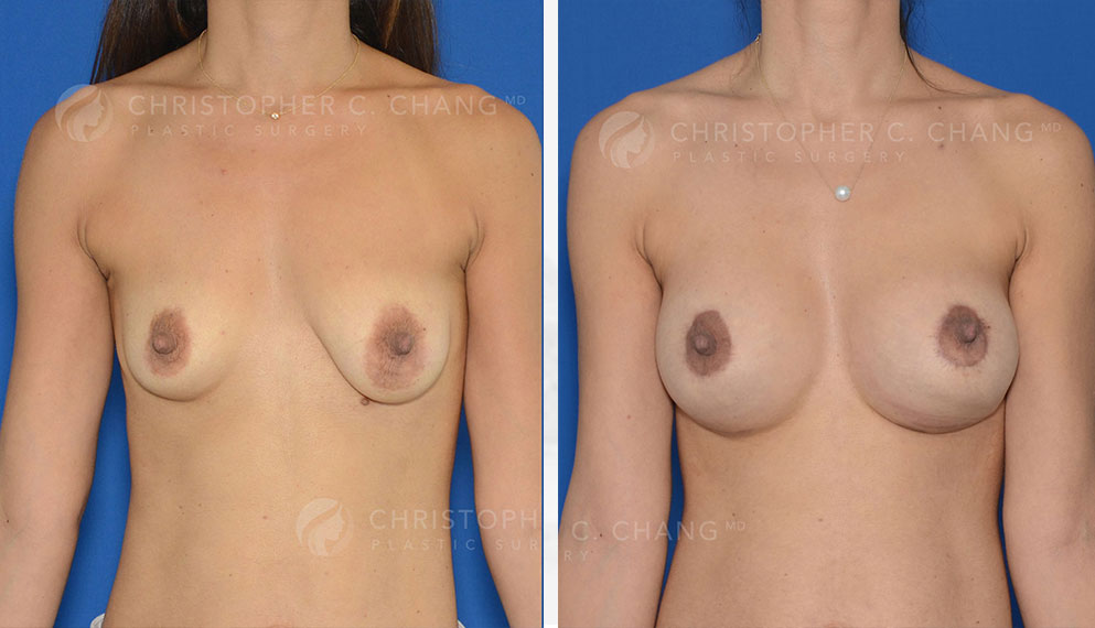 DC Before and After Breast Lift