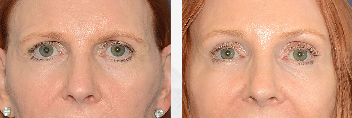 Brow Lift Before & After