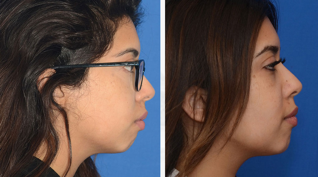 Chin Augmentation Surgery Results