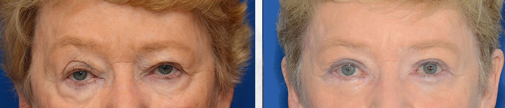 Blepharoplasty Surgery Results