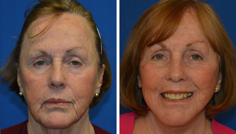 Mini-Facelift Before & After - Dr. Christopher Chang