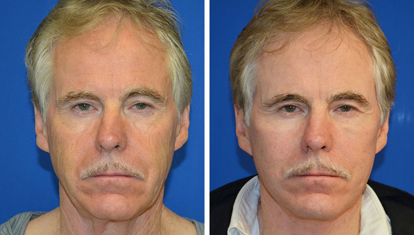 Dr. Christopher Chang - Mini-Facelift Before & After
