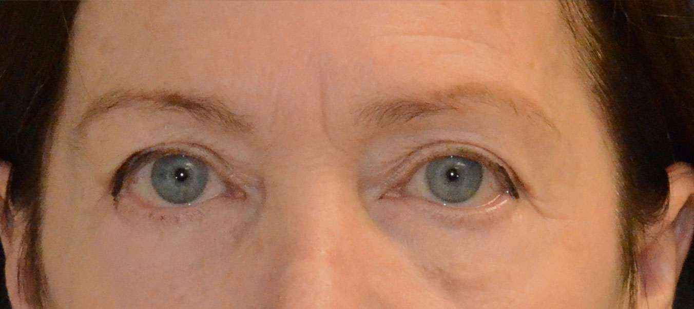 Blepharoplasty Before & After Photo #1