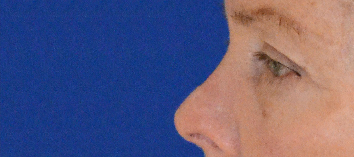 Blepharoplasty Before & After Photo #3