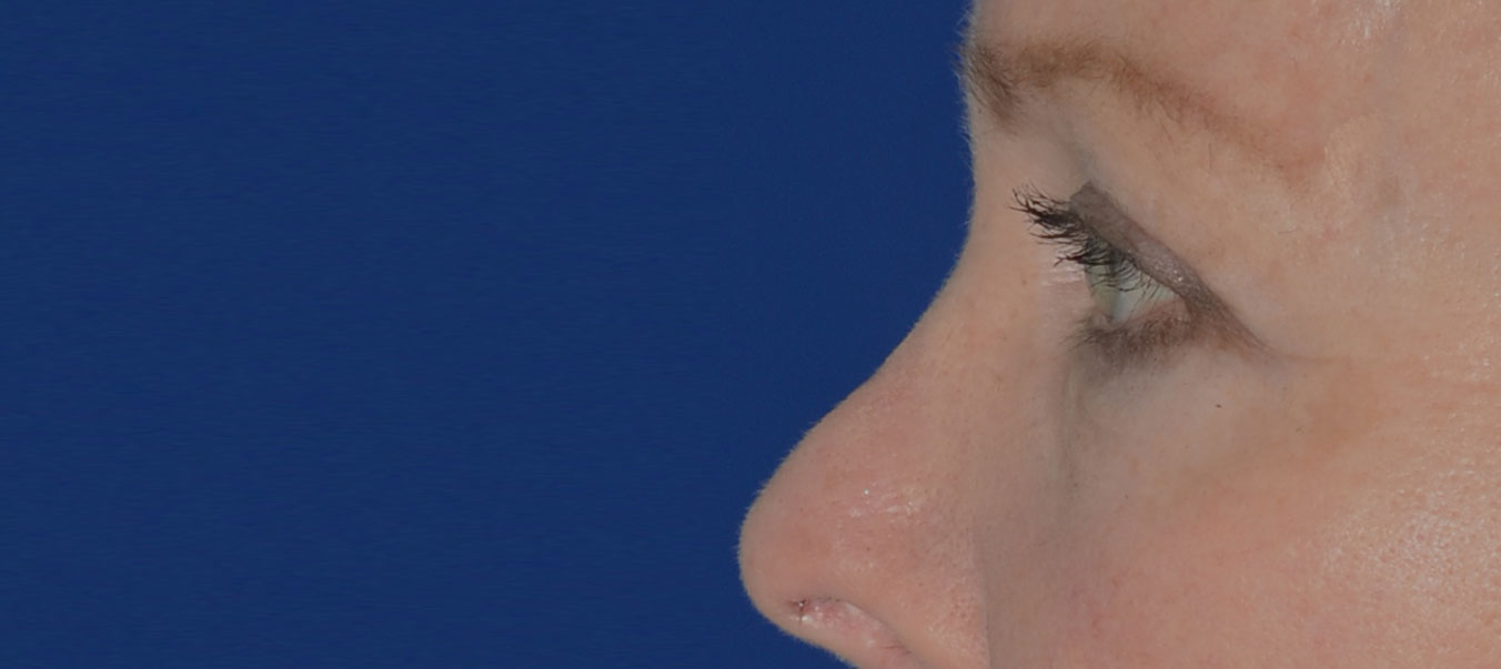 Blepharoplasty Before & After Photo #4