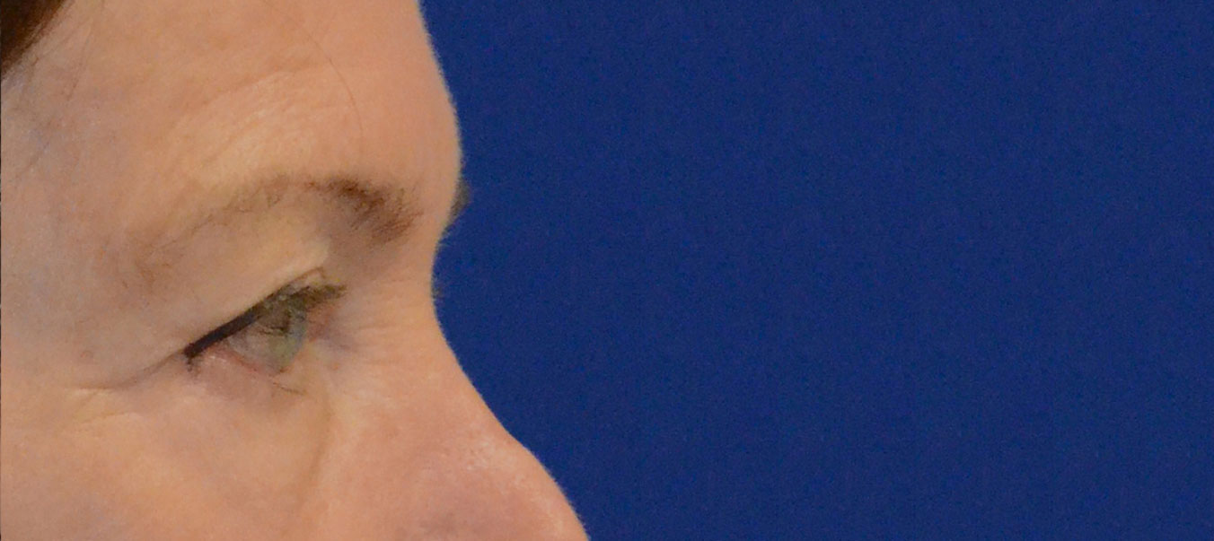 Blepharoplasty Before & After Photo #7