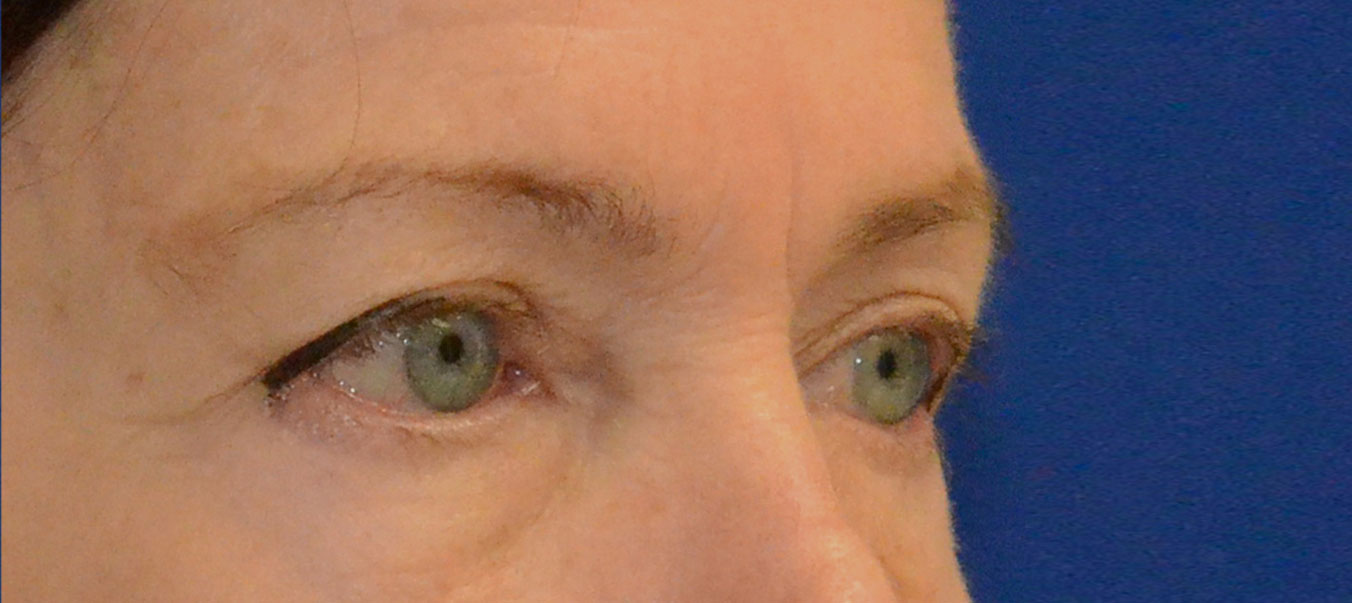 Blepharoplasty Before & After Photo #9