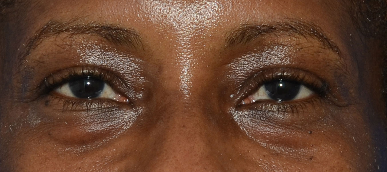 Blepharoplasty Before & After Photo #1