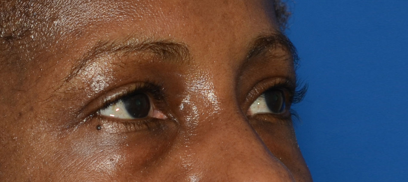 Blepharoplasty Before & After Photo #9