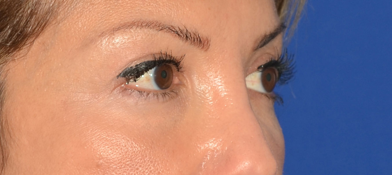 Blepharoplasty Before & After Photo #10