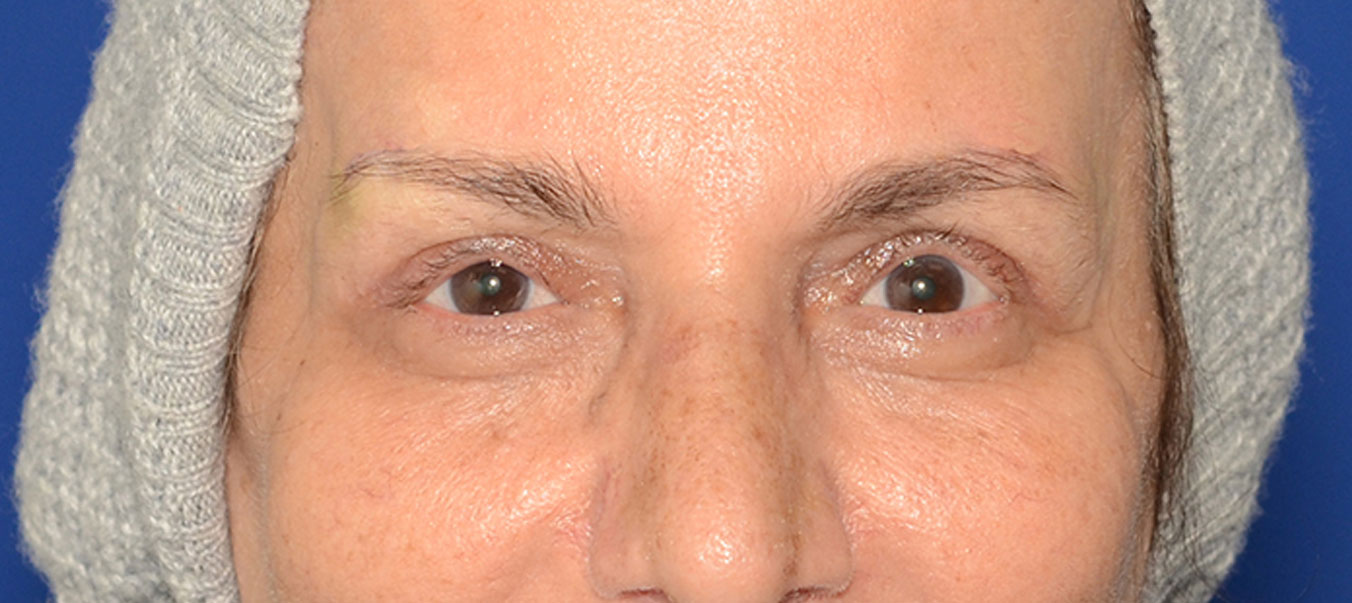 Blepharoplasty Before & After Photo #2