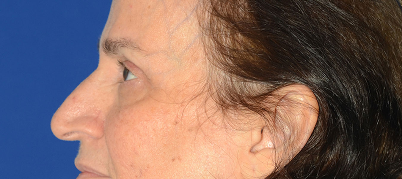 Blepharoplasty Before & After Photo #3