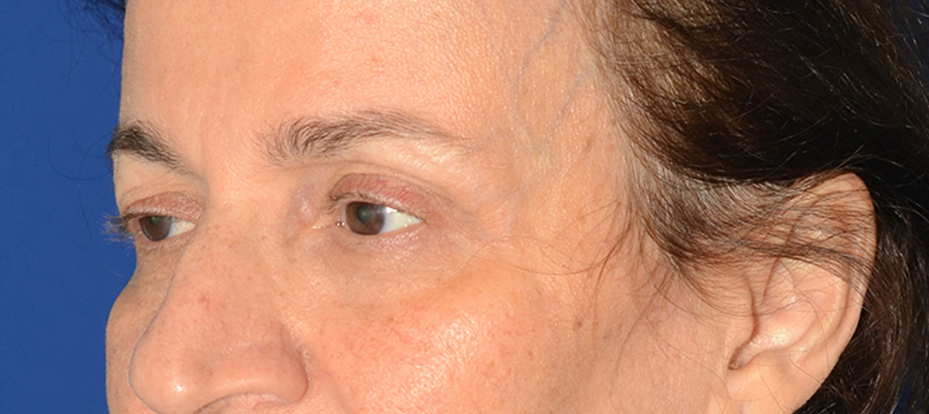 Blepharoplasty Before & After Photo #5