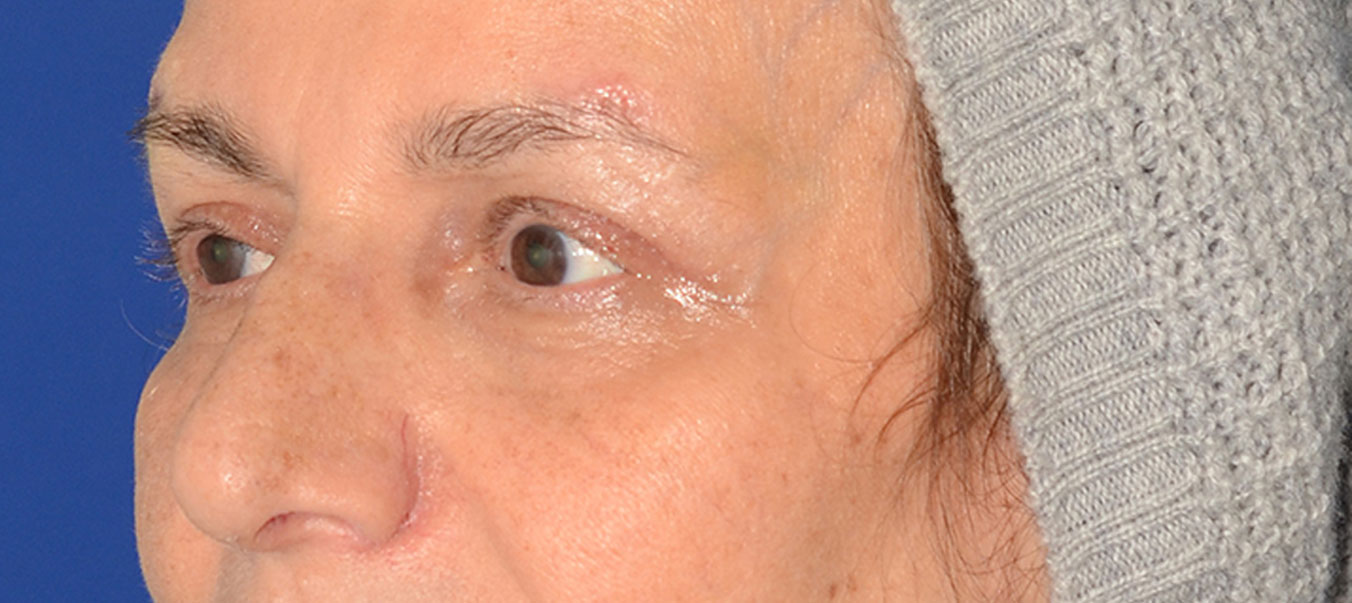 Blepharoplasty Before & After Photo #6