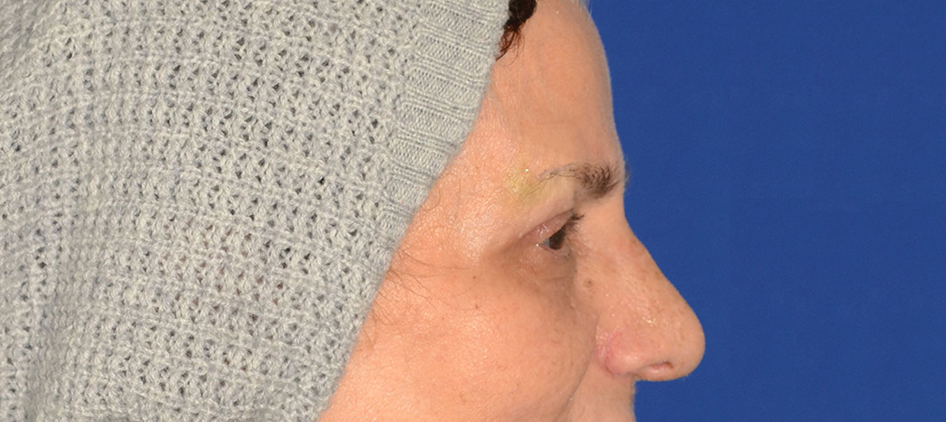 Blepharoplasty Before & After Photo #8