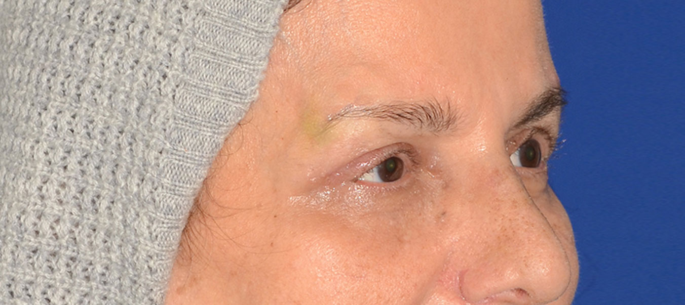 Blepharoplasty Before & After Photo #10