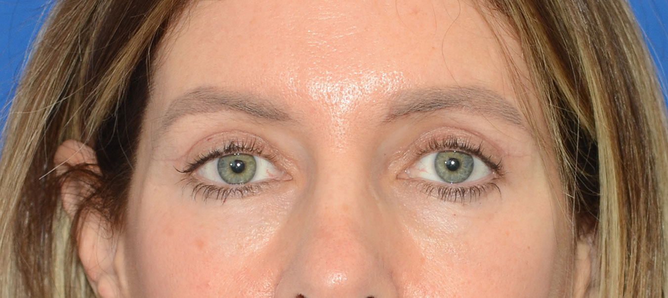 Blepharoplasty Before & After Photo #2
