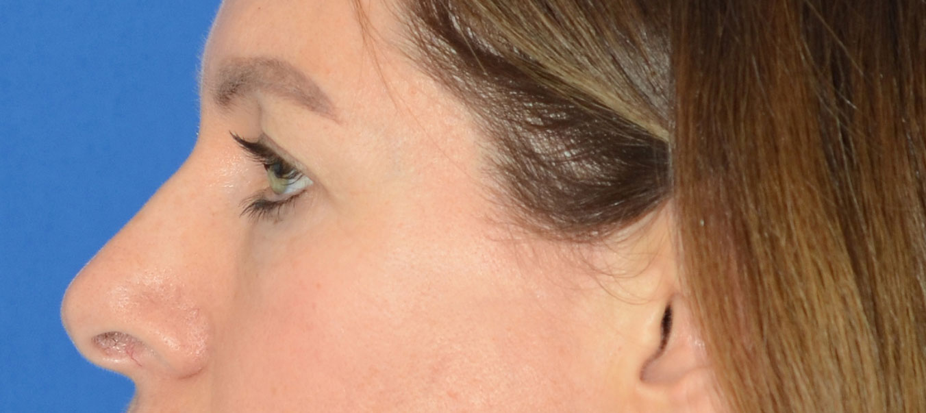 Blepharoplasty Before & After Photo #5