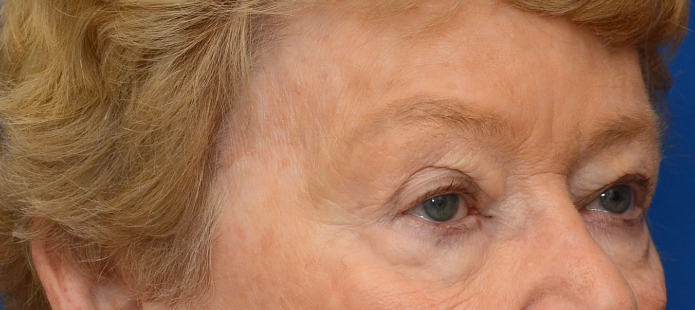 Blepharoplasty Before & After Photo #7
