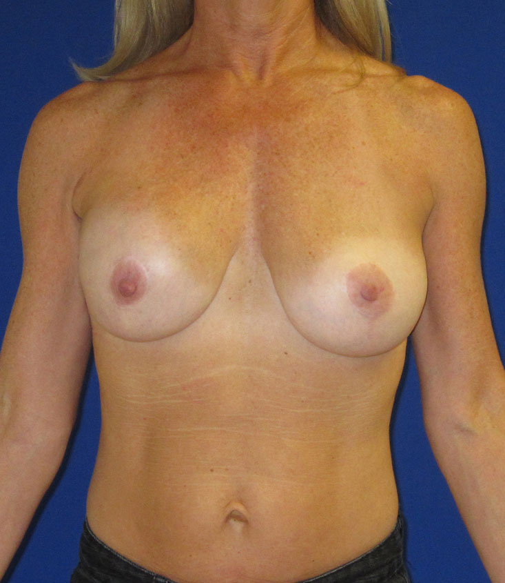 Breast Augmentation And Lift Before & After Photo #1