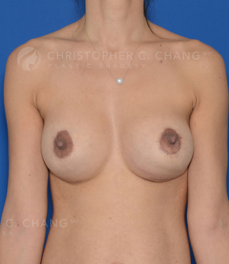 Breast Augmentation And Lift Before & After Photo #2