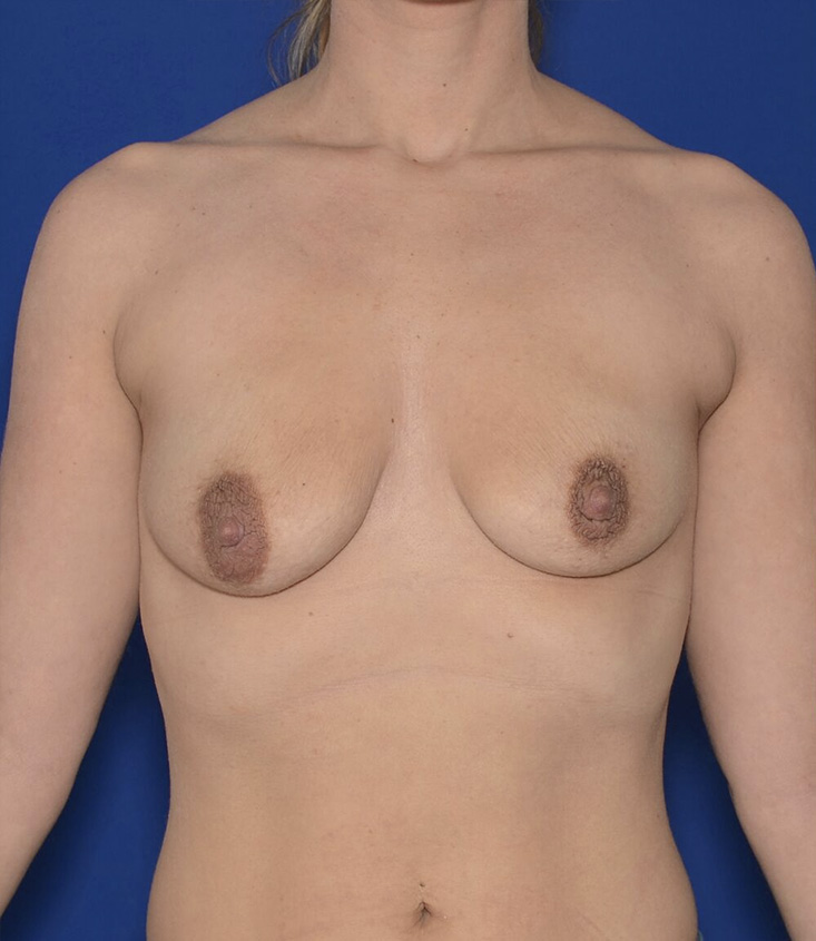 Breast Augmentation And Lift Before & After Photo #1