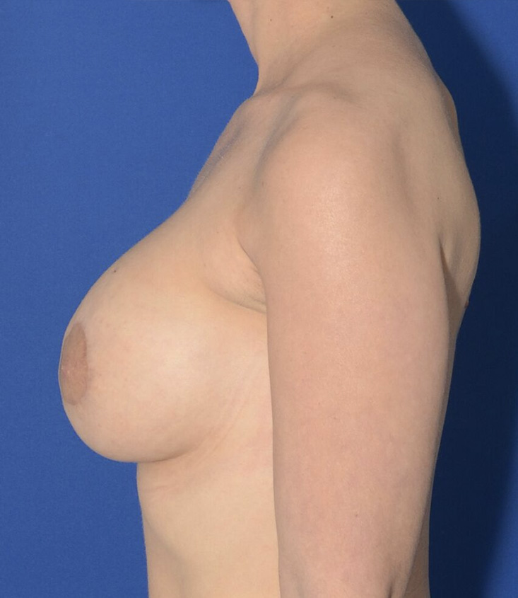 Breast Augmentation And Lift Before & After Photo #10