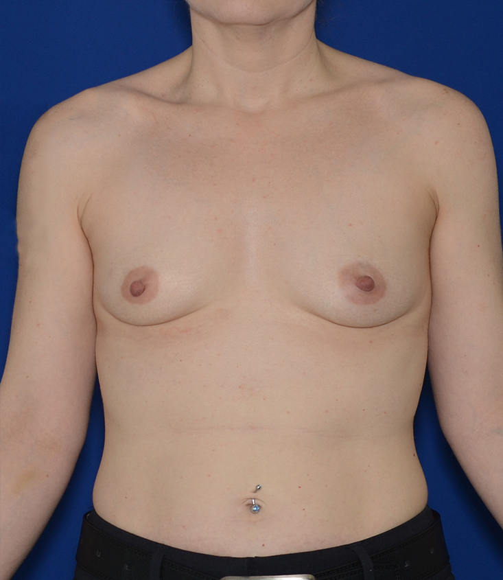 Breast Augmentation Before & After Photo #1