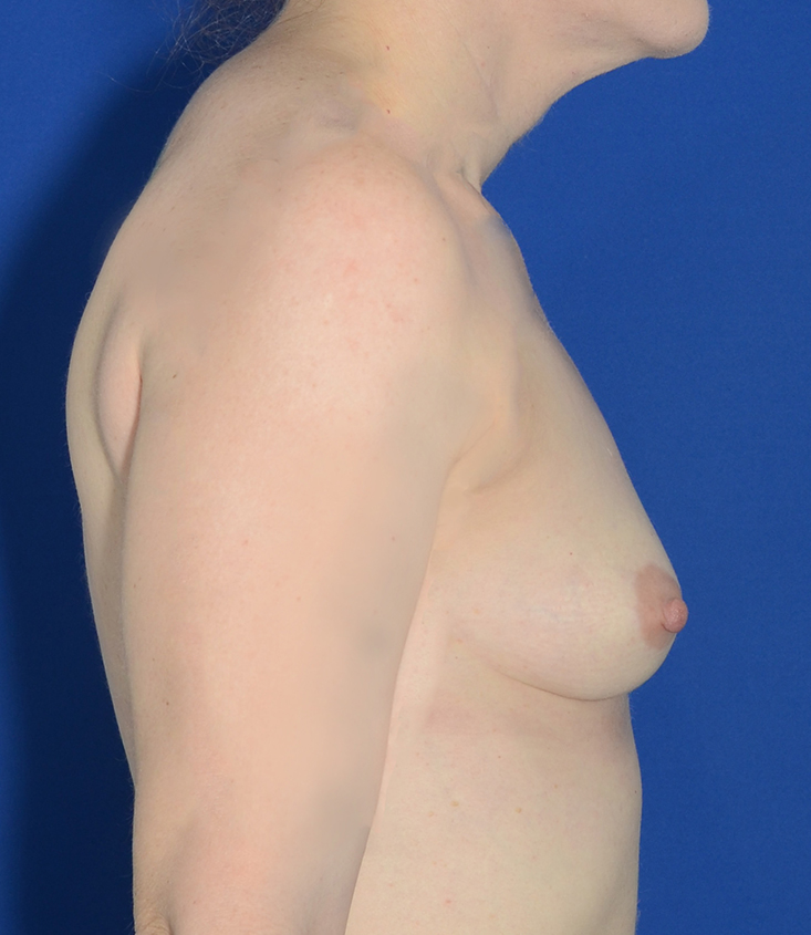Breast Augmentation Before & After Photo #7