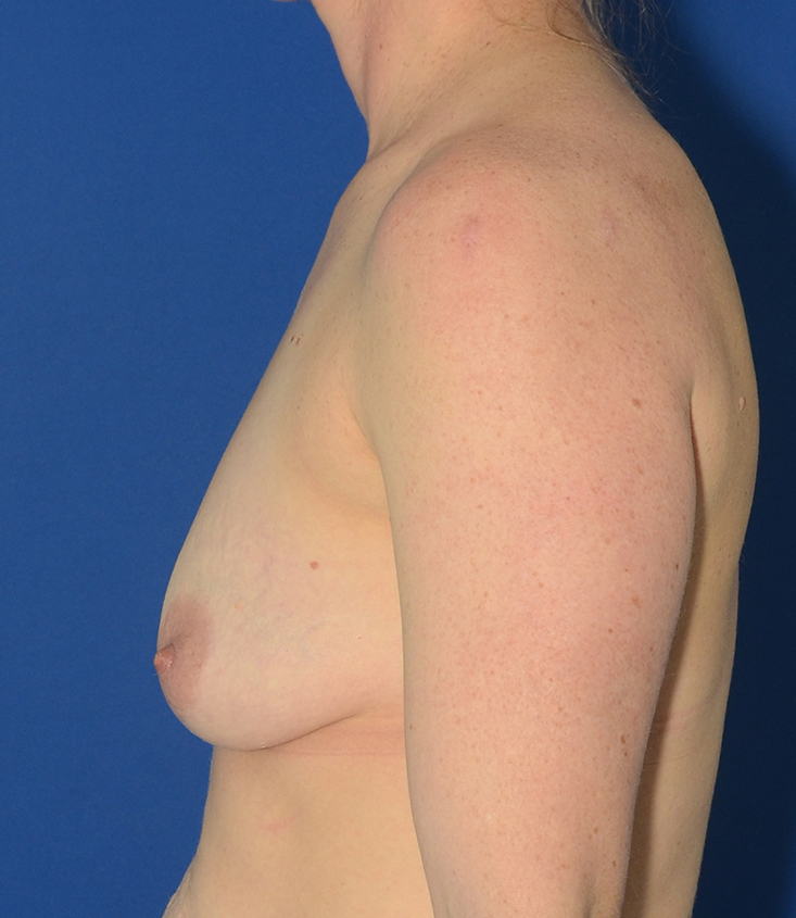 Breast Augmentation Before & After Photo #3