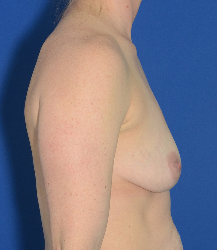 Breast Augmentation Before & After Photo #7