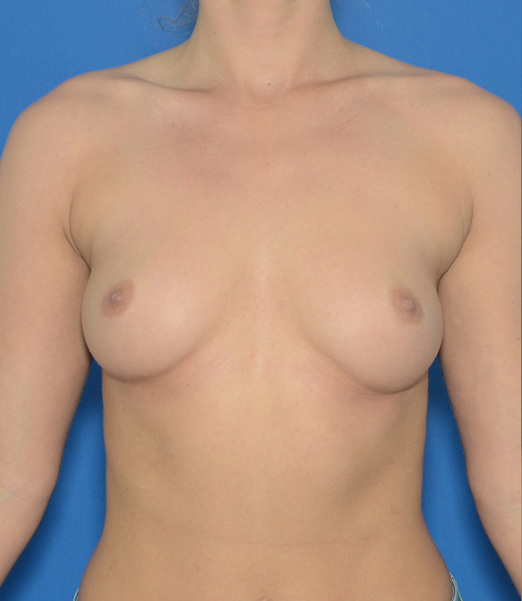 Breast Augmentation Before & After Photo #1