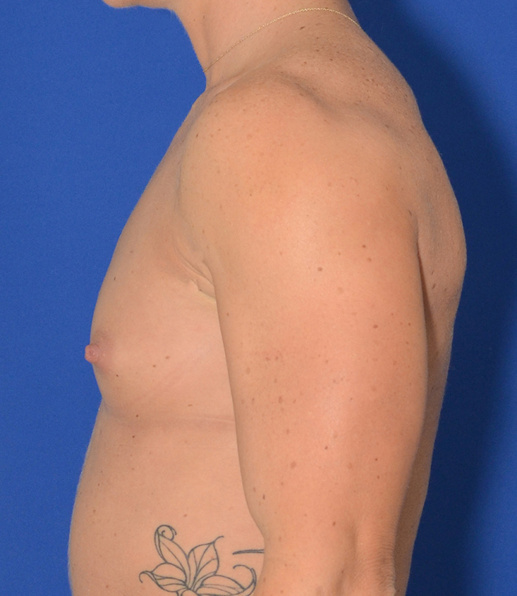 Breast Augmentation Before & After Photo #3