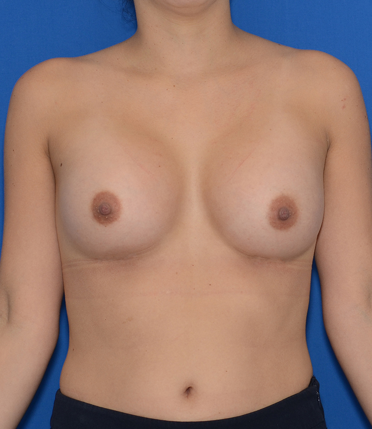 Breast Augmentation Before & After Photo #2