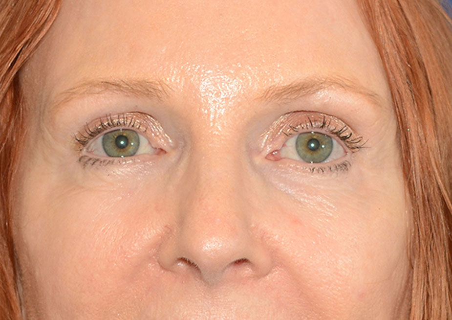 Brow Lift Before & After Photo #2