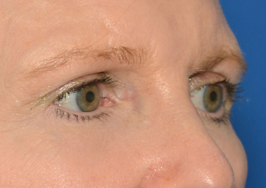 Brow Lift Before & After Photo #9