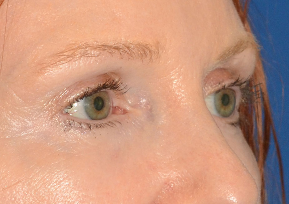 Brow Lift Before & After Photo #10