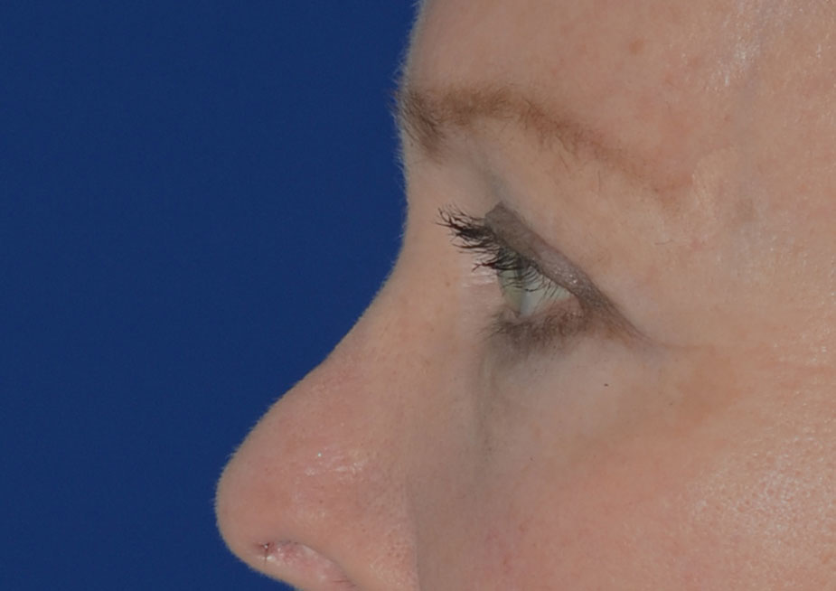 Brow Lift Before & After Photo #4