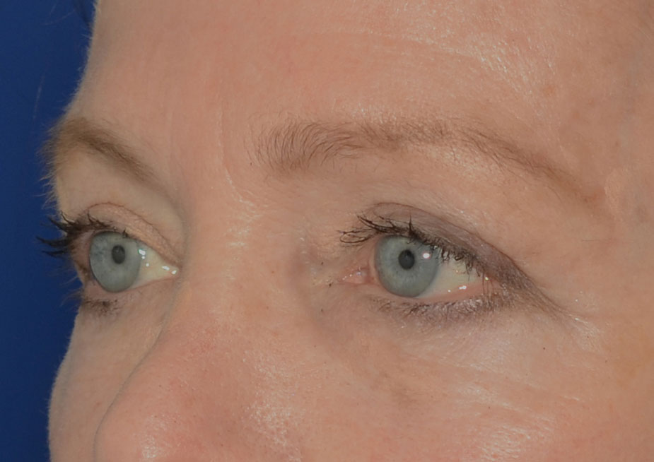 Brow Lift Before & After Photo #6