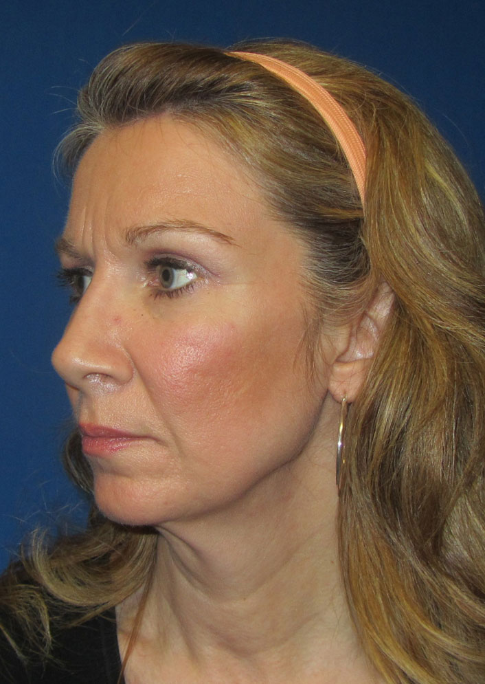Facelift Before & After Photo #1